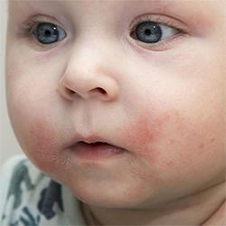 Infant with Eczema around mouth and cheeks